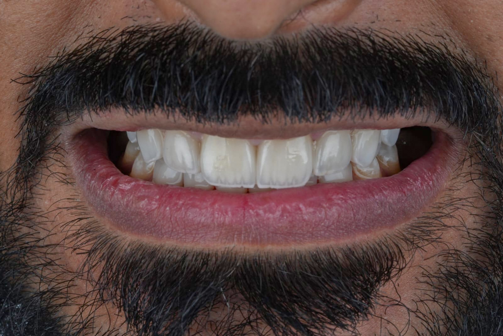 بعد ترميم وتجميل الأسنان